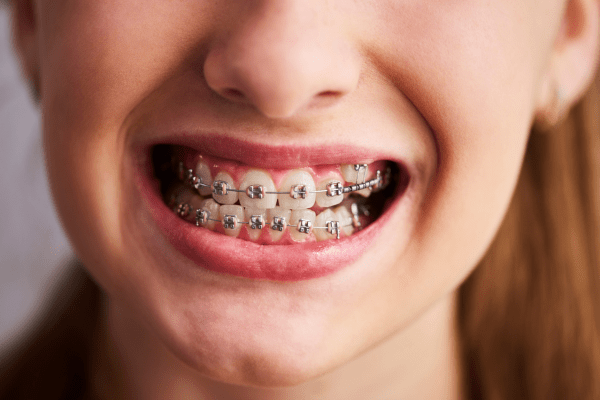 Orthodontic-Treatment