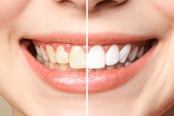 Teeth-Whitening-