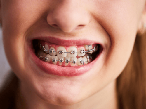 Orthodontic-Treatment