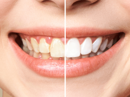 Teeth-Whitening-