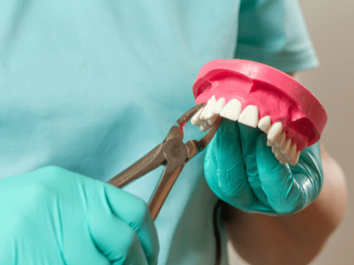 Tooth-Removal-Extraction